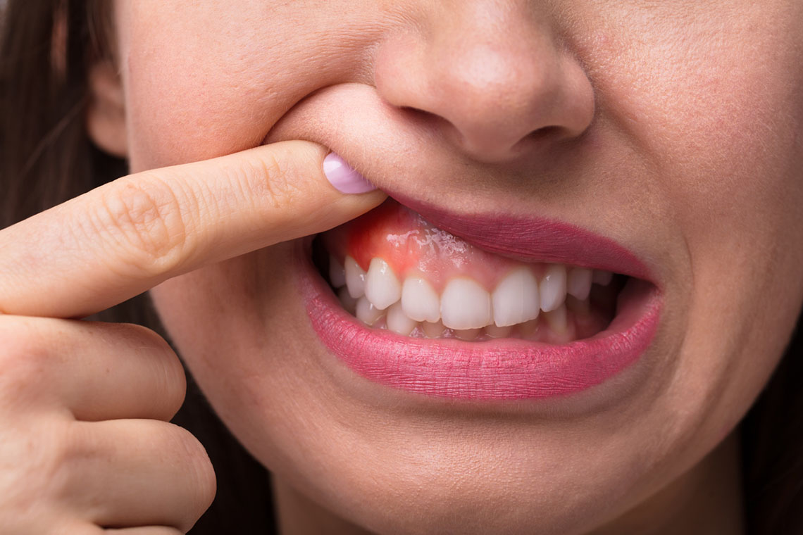 Natural Ways to Promote Gum Healing
