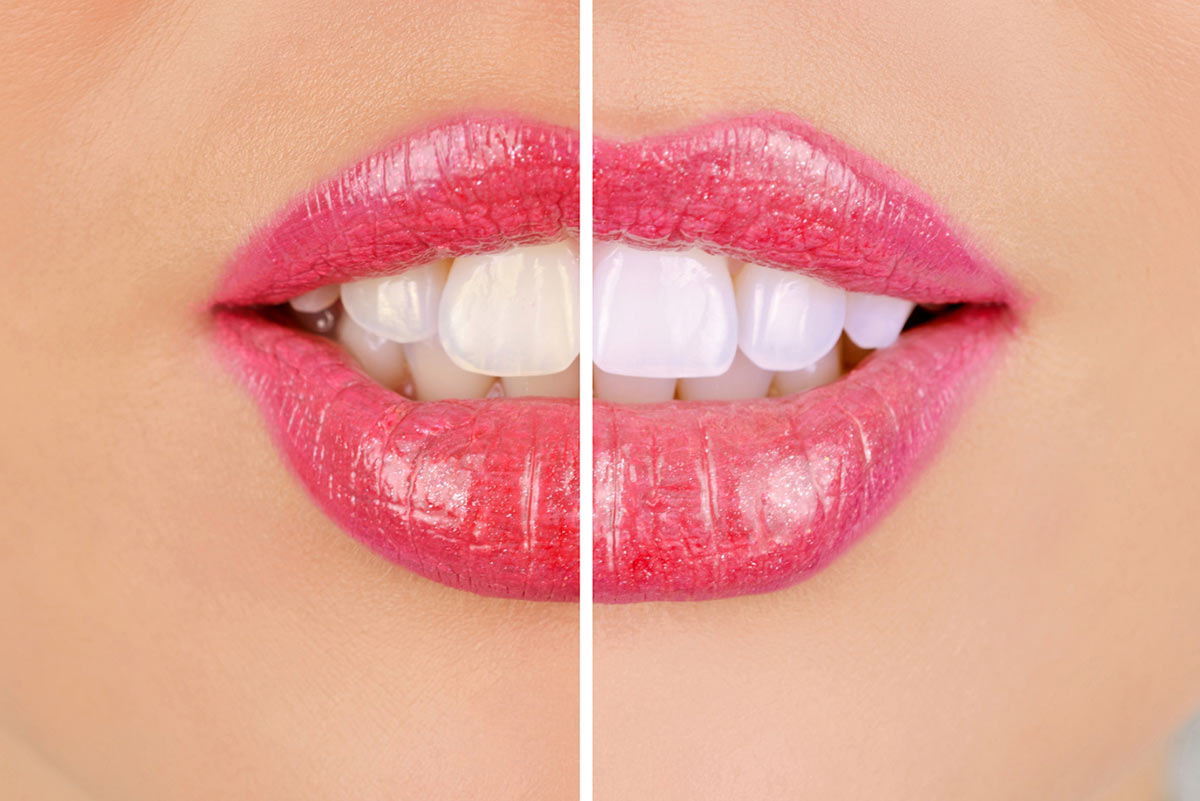 Teeth Stains and Discolouration