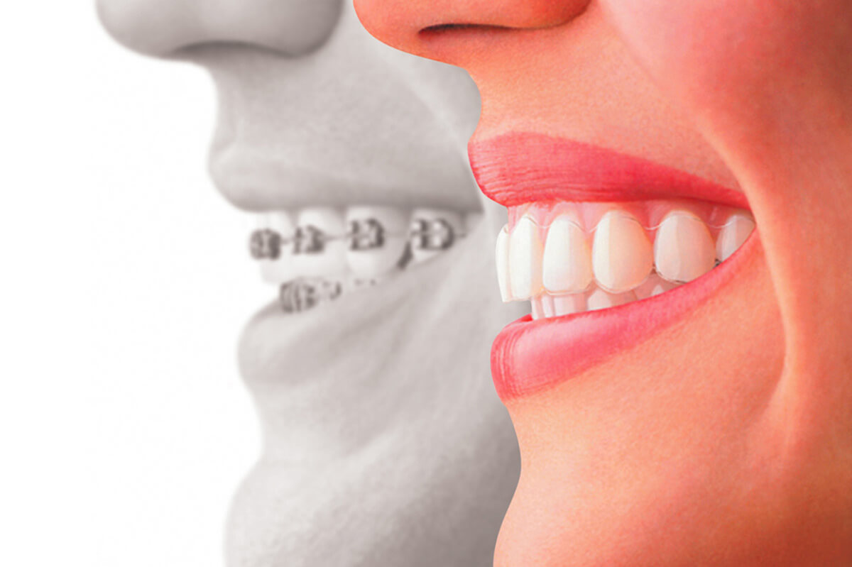 What are Invisalign Clear Braces? - Stoney Creek Dental