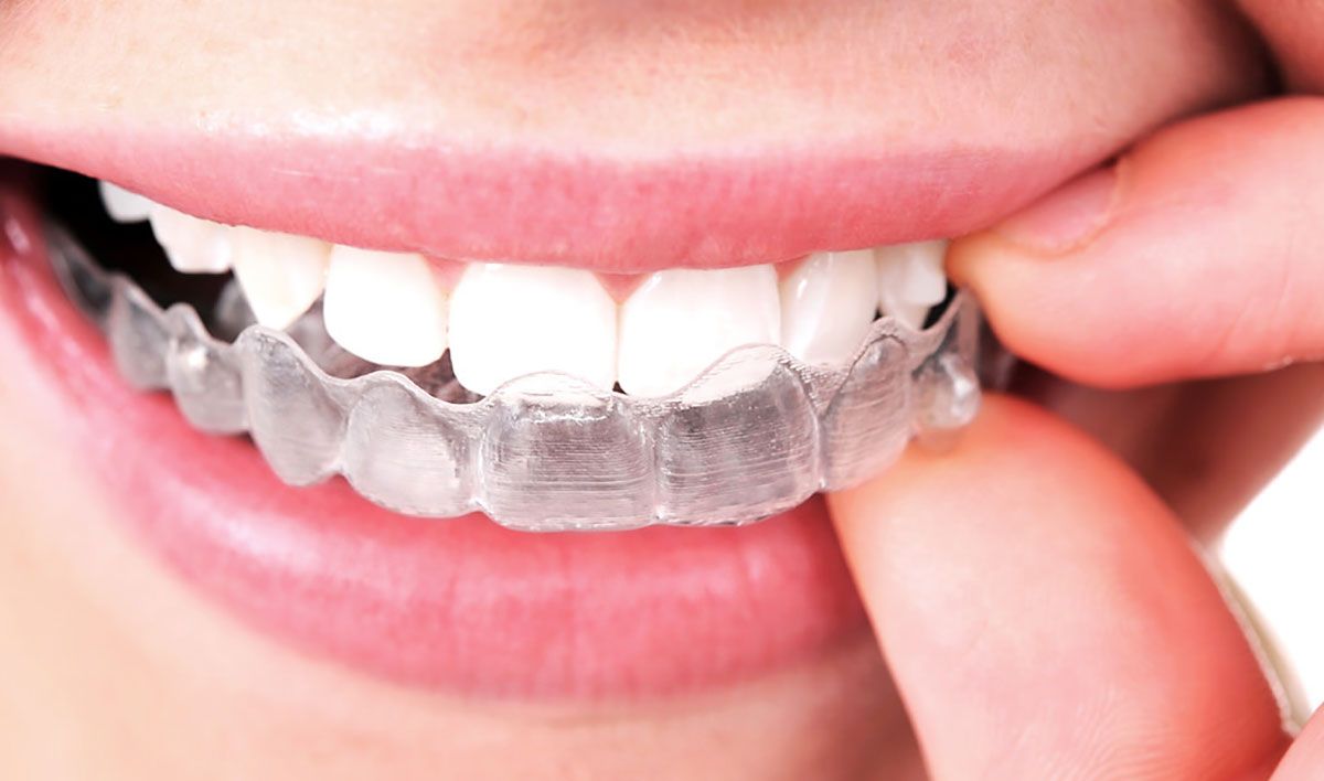 What are Invisalign Clear Braces? - Stoney Creek Dental
