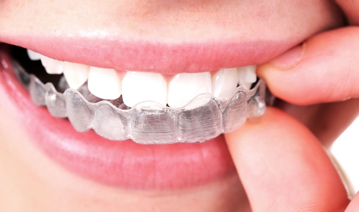 Clear Invisible Braces, Invisalign Clear Braces In Bolton - Dr Howarth  Dental