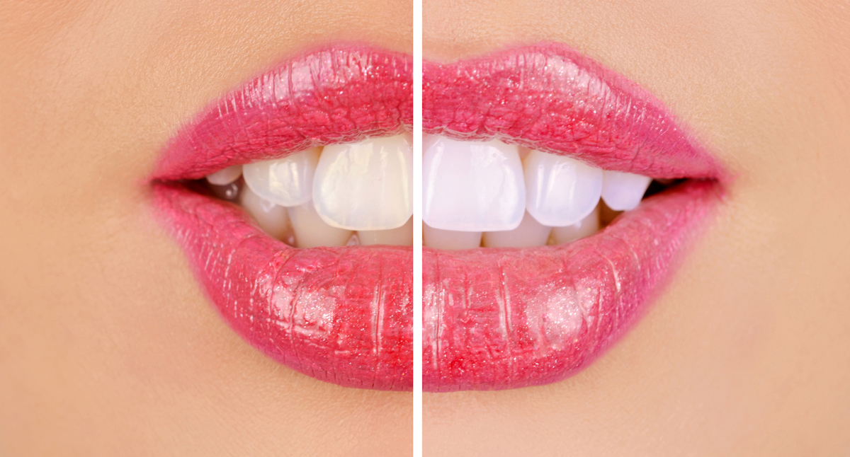 The Top 4 Teeth Whitening Options