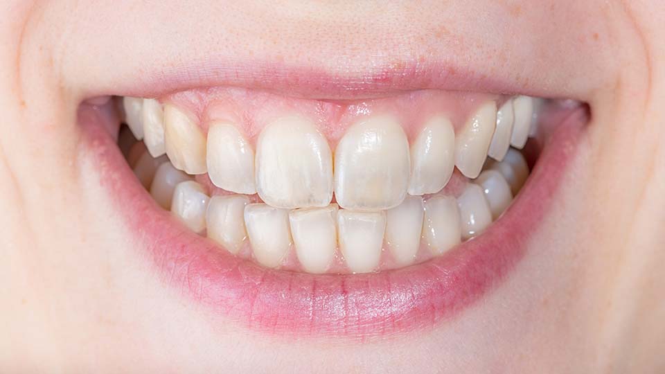 tooth erosion and discoloration