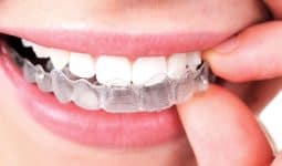 What are Invisalign Clear Braces? - Stoney Creek Dental