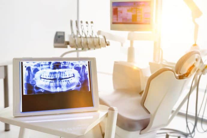 Common Wisdom Teeth Removal Questions