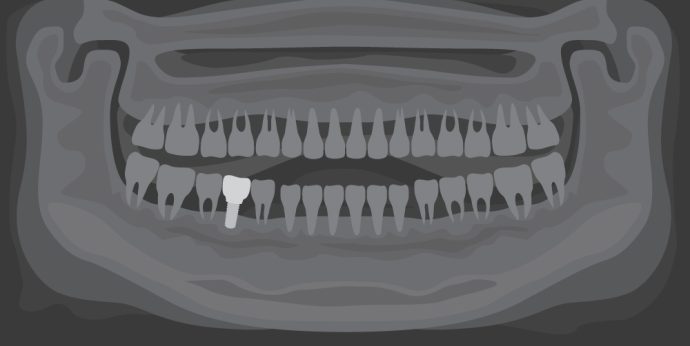 The Importance of a Healthy Foundation: Understanding Implant Dentistry
