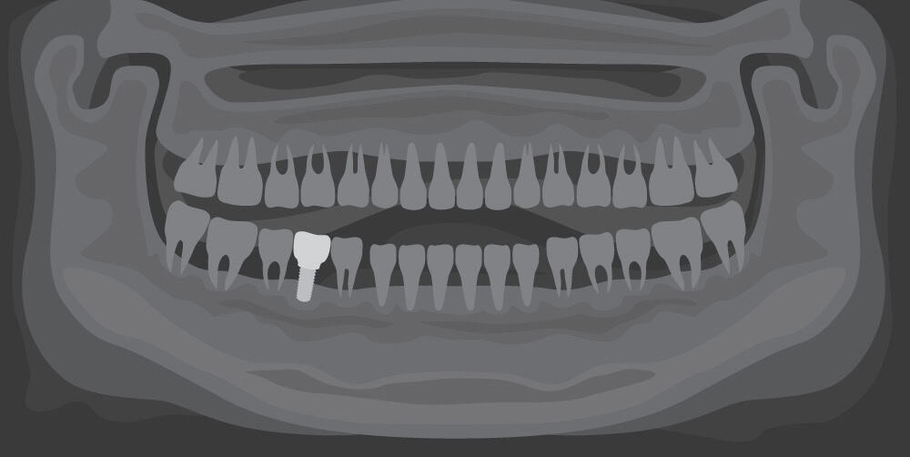 The Importance of a Healthy Foundation: Understanding Implant Dentistry